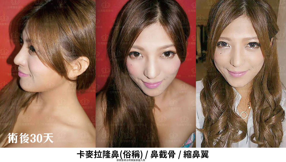 卡麥拉隆鼻,鼻截骨,縮鼻翼