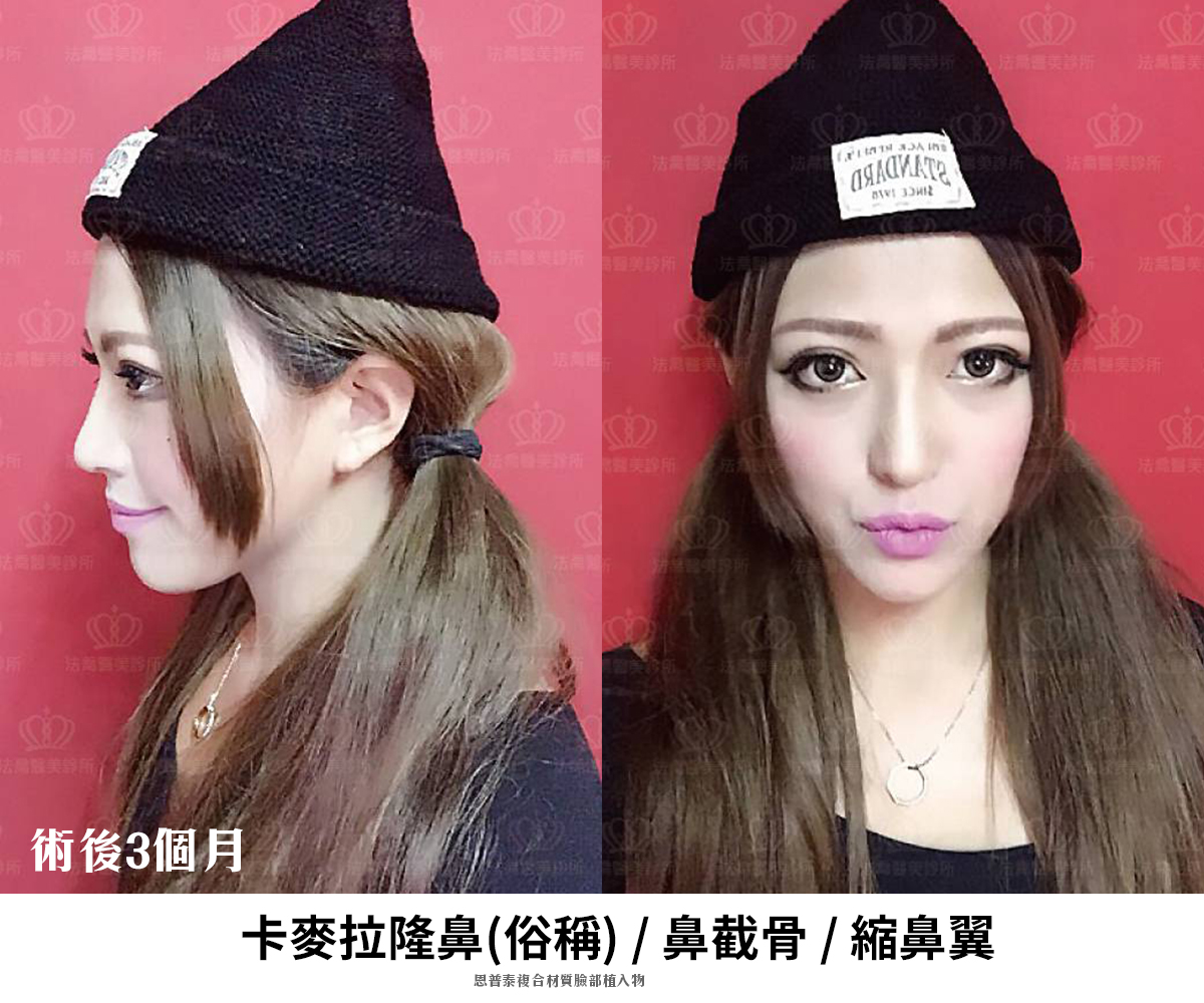 卡麥拉隆鼻,鼻截骨,縮鼻翼