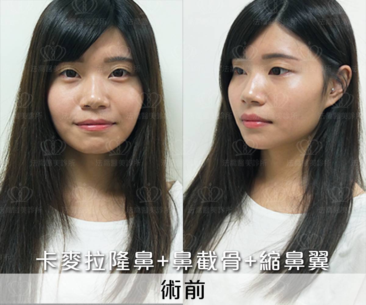 卡麥拉隆鼻,鼻截骨,縮鼻翼