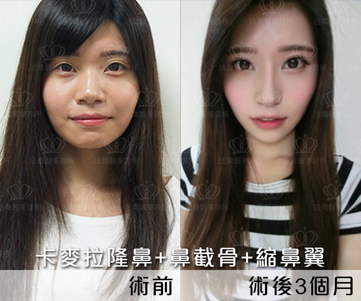 卡麥拉隆鼻,鼻截骨,縮鼻翼