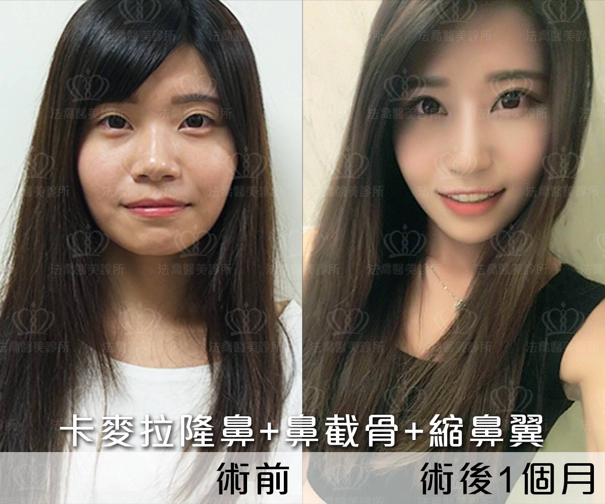 卡麥拉隆鼻,鼻截骨,縮鼻翼