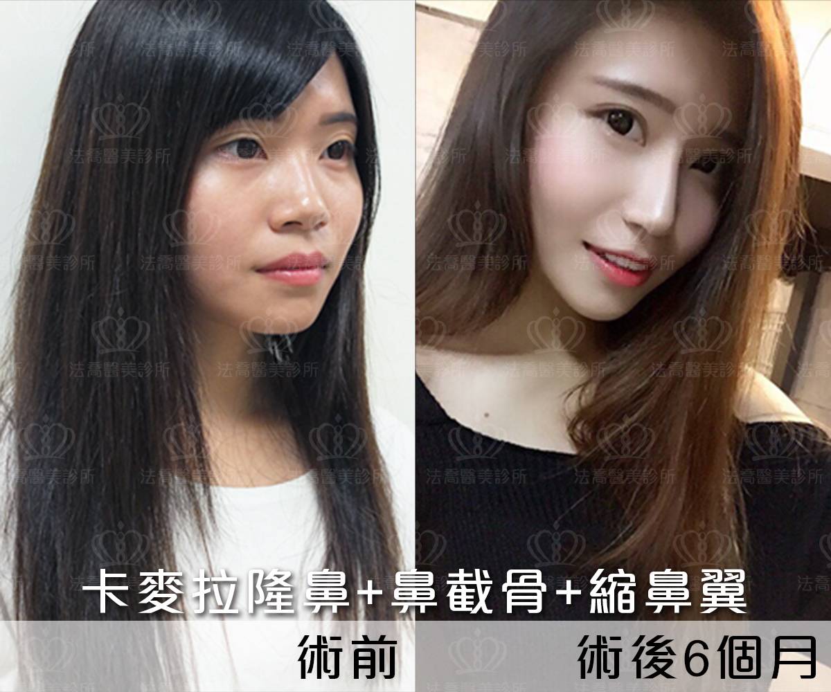 卡麥拉隆鼻,鼻截骨,縮鼻翼