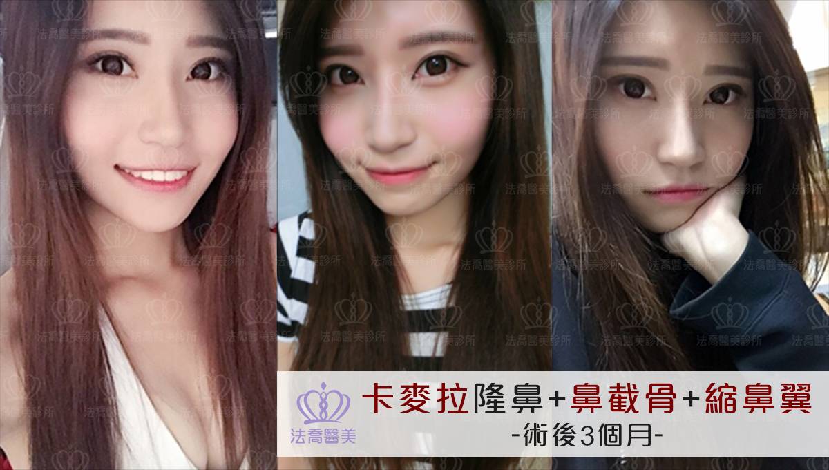 卡麥拉隆鼻,鼻截骨,縮鼻翼