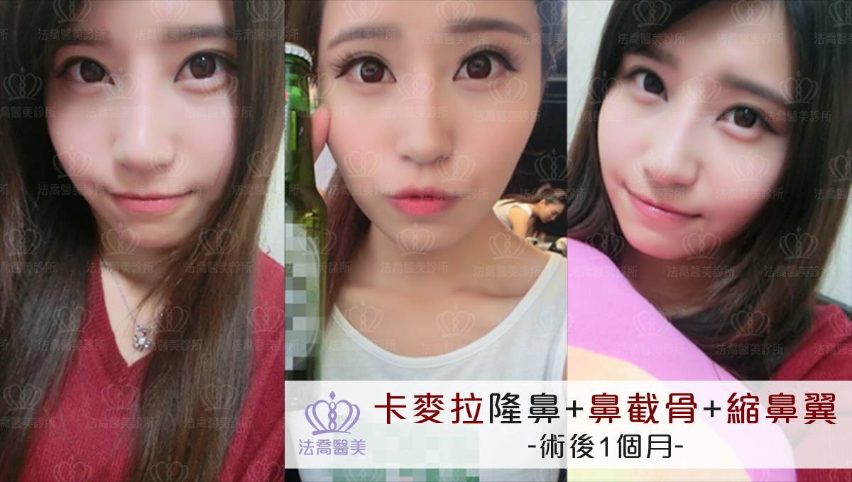 卡麥拉隆鼻,鼻截骨,縮鼻翼