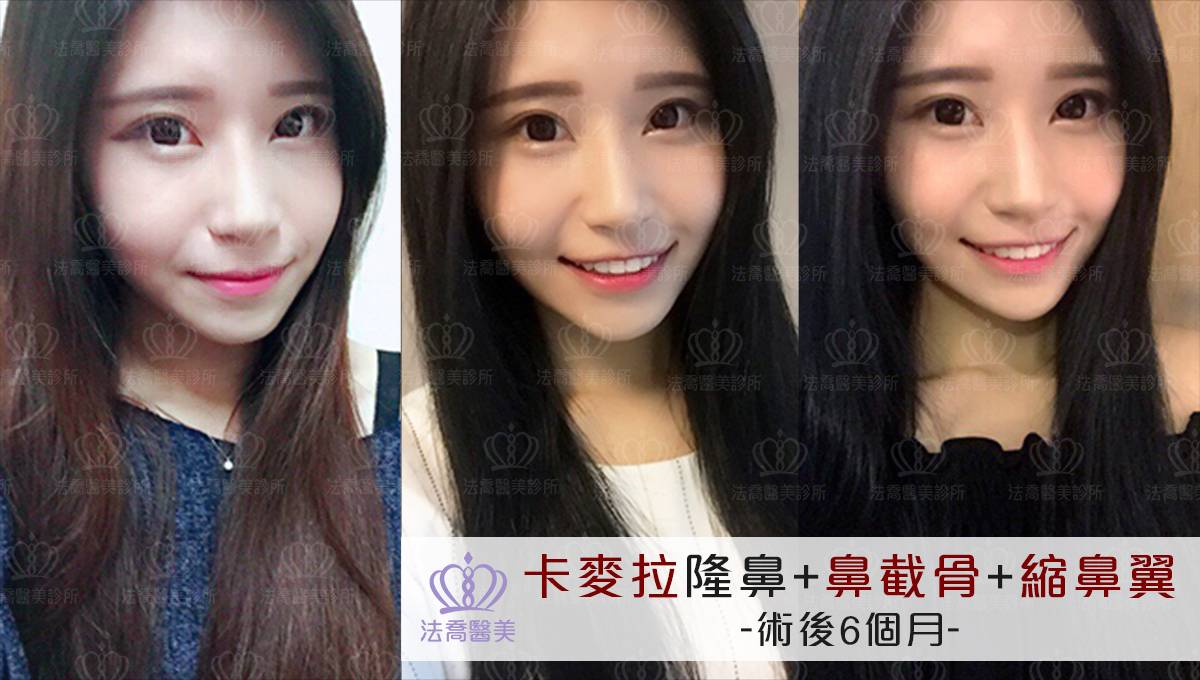 卡麥拉隆鼻,鼻截骨,縮鼻翼