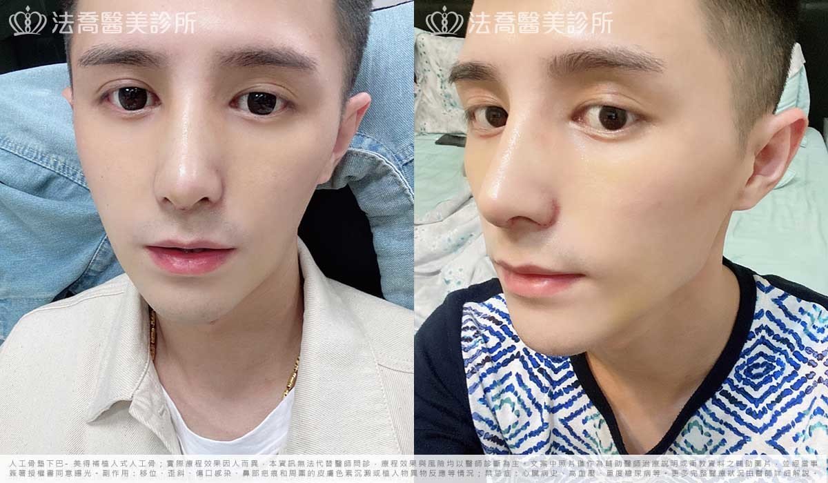 自體肋骨隆鼻,鼻截骨,縮鼻翼,墊下巴