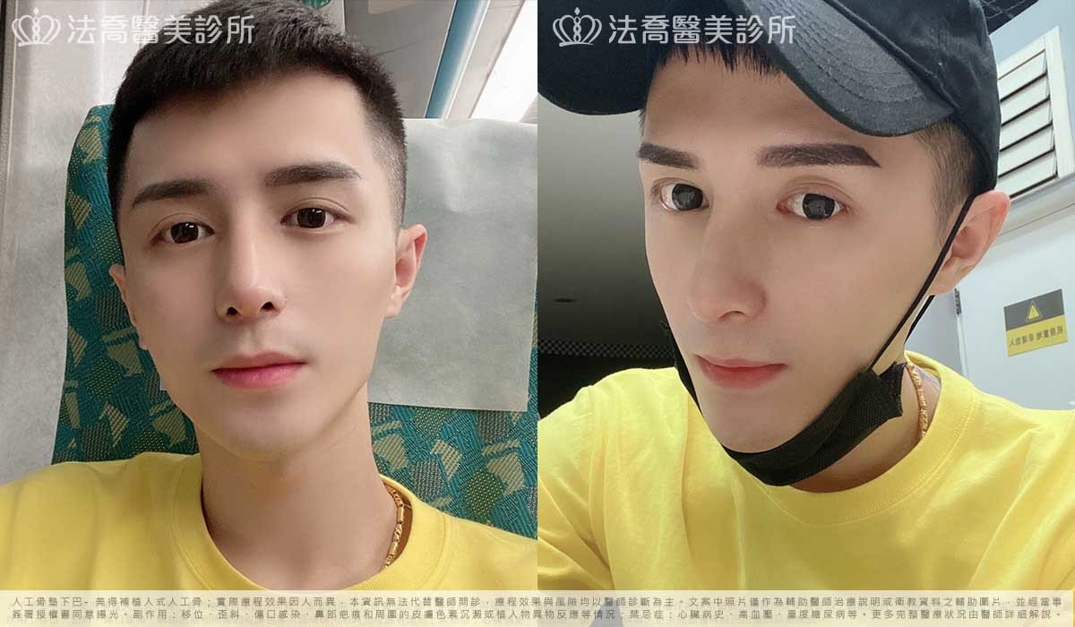 自體肋骨隆鼻,鼻截骨,縮鼻翼,墊下巴
