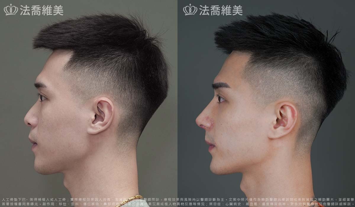 自體肋骨隆鼻,鼻截骨,縮鼻翼,墊下巴