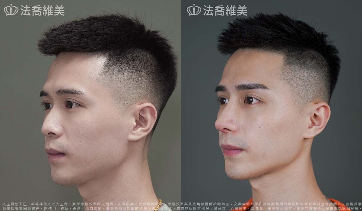 自體肋骨隆鼻,鼻截骨,縮鼻翼,墊下巴