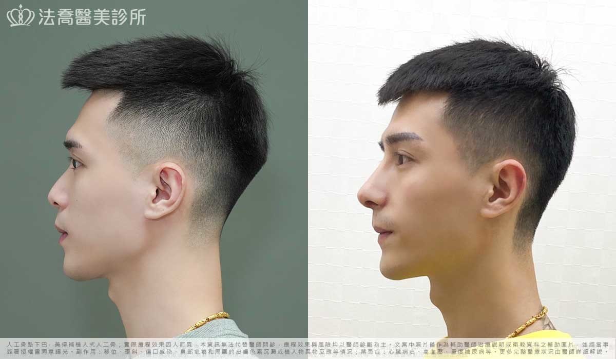自體肋骨隆鼻,鼻截骨,縮鼻翼,墊下巴