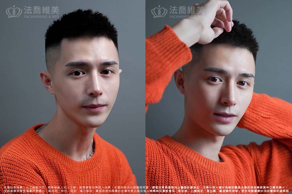 自體肋骨隆鼻,鼻截骨,縮鼻翼,墊下巴