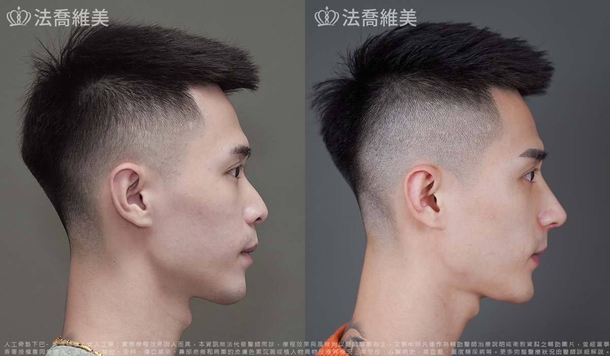 自體肋骨隆鼻,鼻截骨,縮鼻翼,墊下巴
