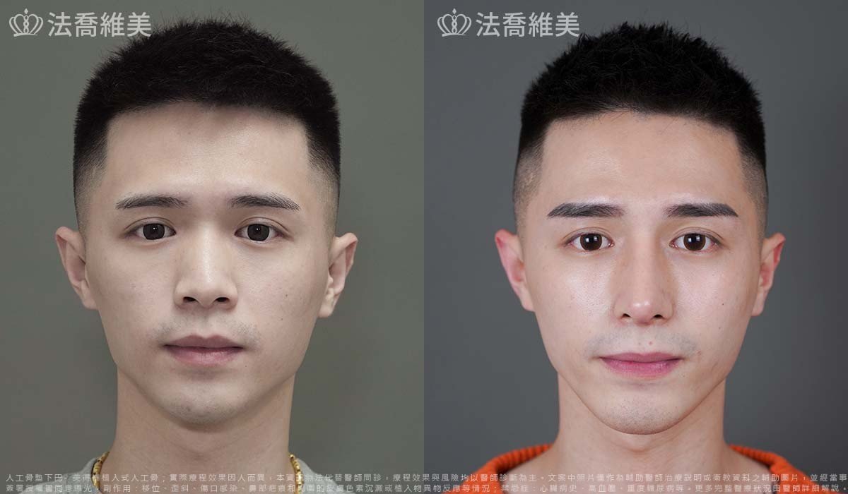 自體肋骨隆鼻,鼻截骨,縮鼻翼,墊下巴