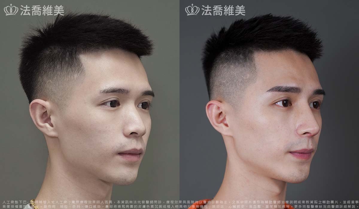 自體肋骨隆鼻,鼻截骨,縮鼻翼,墊下巴