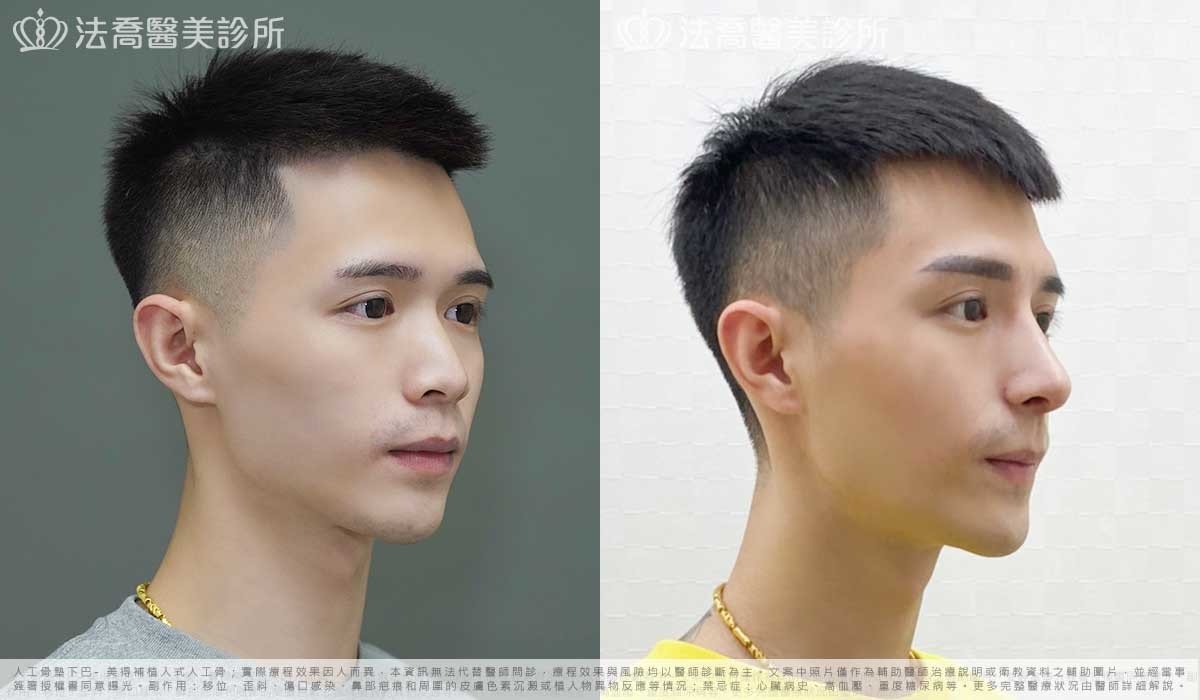 自體肋骨隆鼻,鼻截骨,縮鼻翼,墊下巴