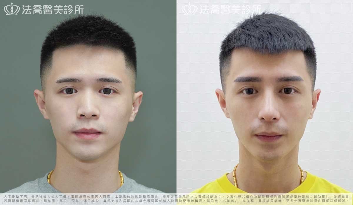 自體肋骨隆鼻,鼻截骨,縮鼻翼,墊下巴