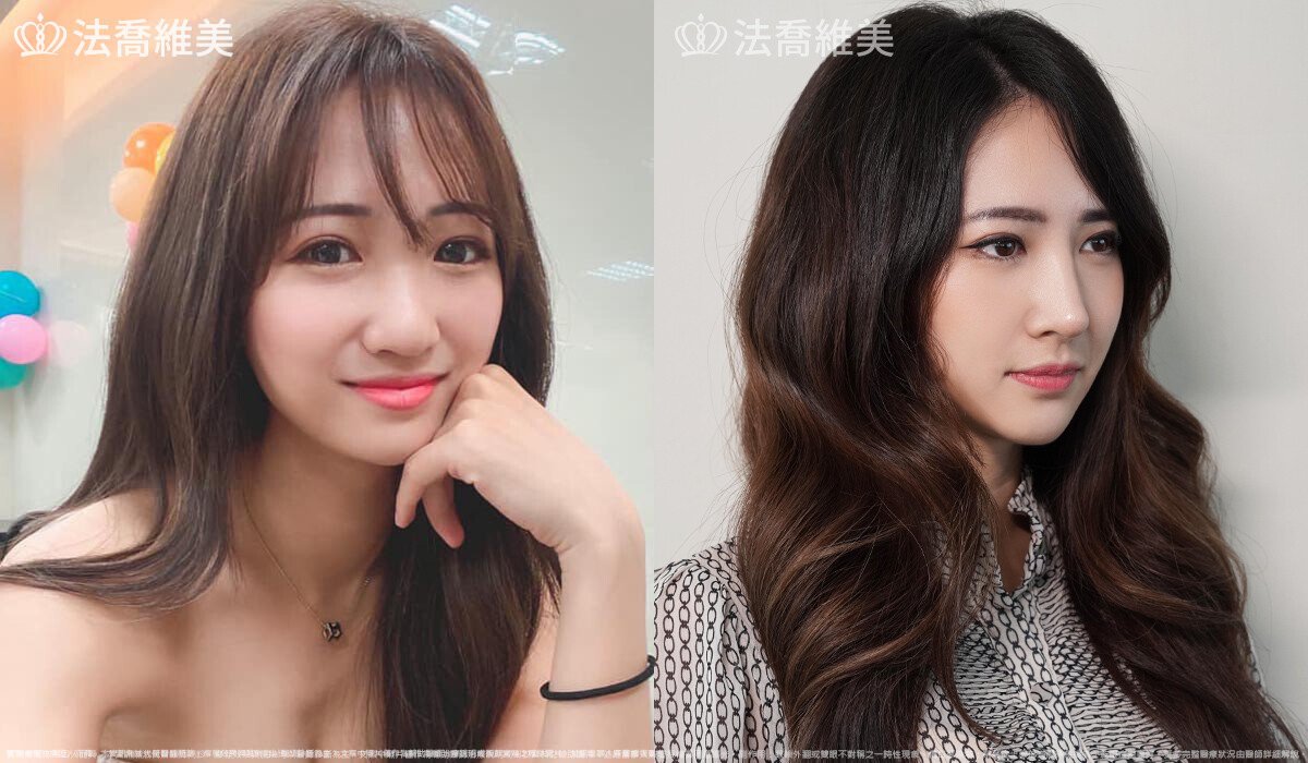 自體肋骨隆鼻,鼻截骨,術前畫線