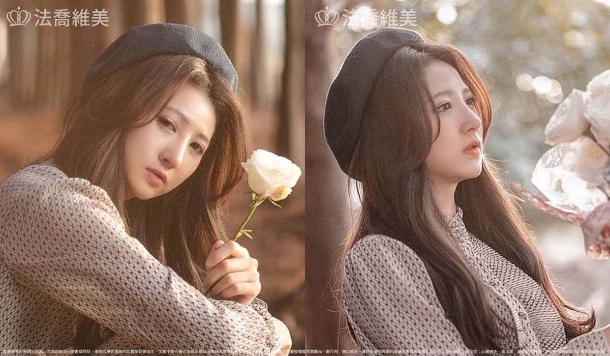 自體肋骨隆鼻,鼻截骨,術前畫線