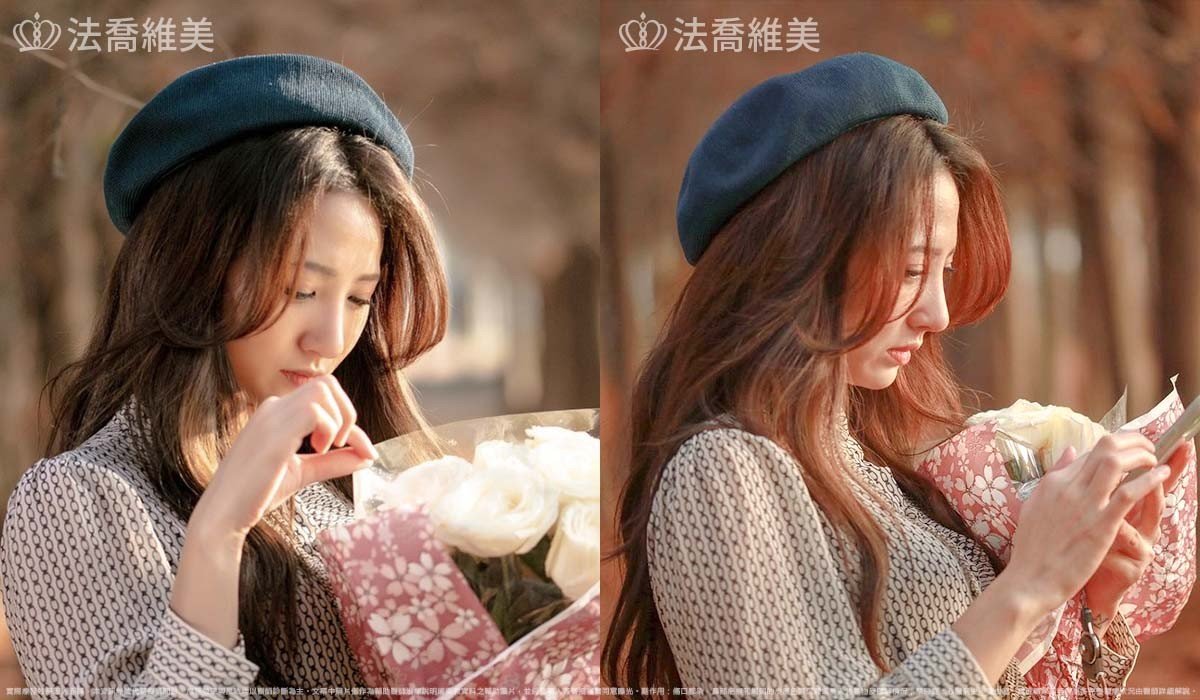 自體肋骨隆鼻,鼻截骨,術前畫線