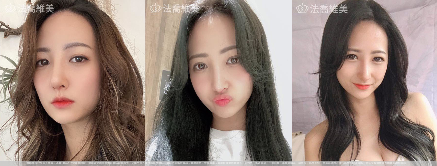 自體肋骨隆鼻,鼻截骨,術前畫線