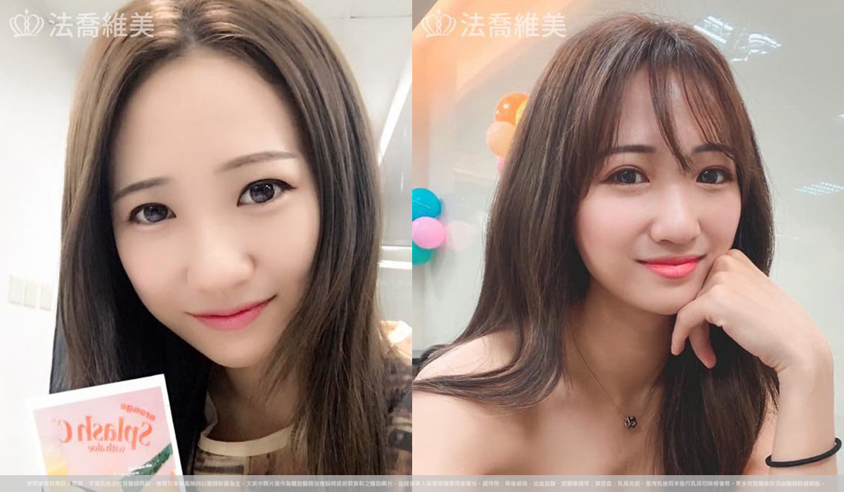 自體肋骨隆鼻,鼻截骨