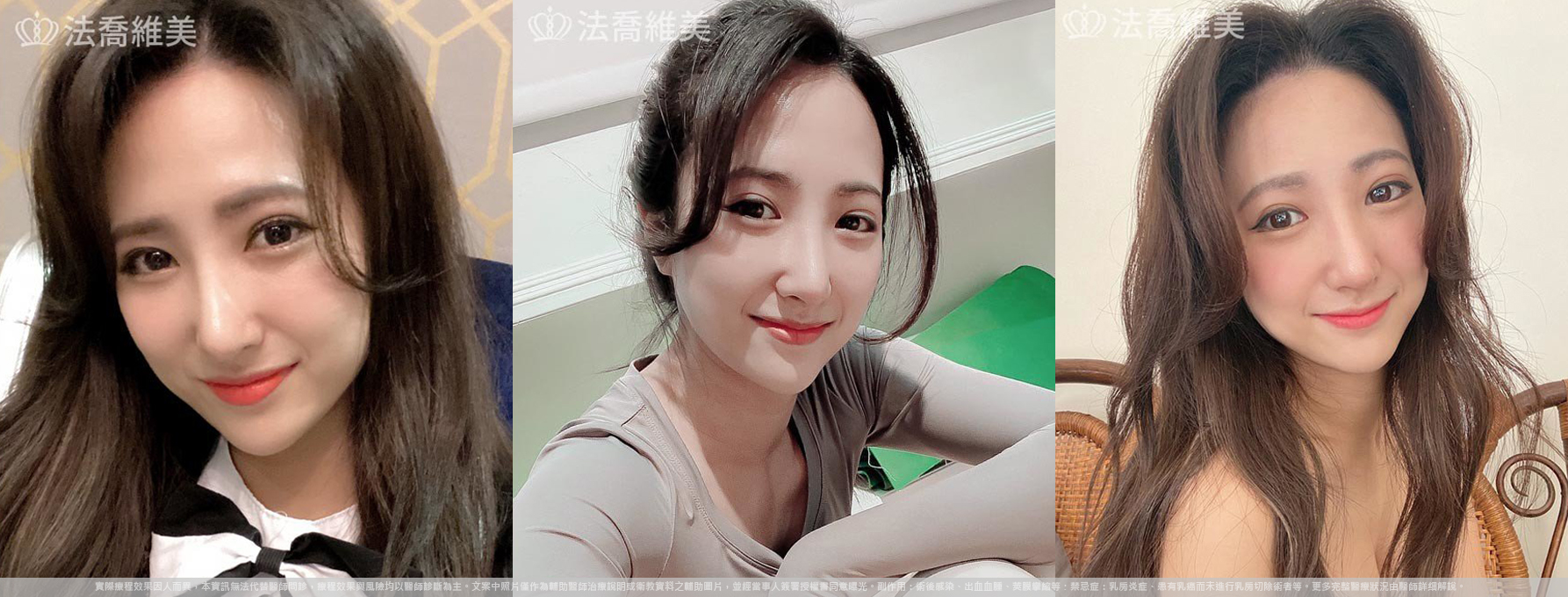 自體肋骨隆鼻,鼻截骨,術前畫線