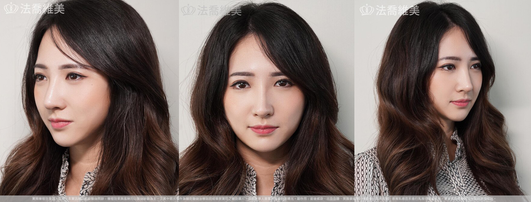 自體肋骨隆鼻,鼻截骨,術前畫線