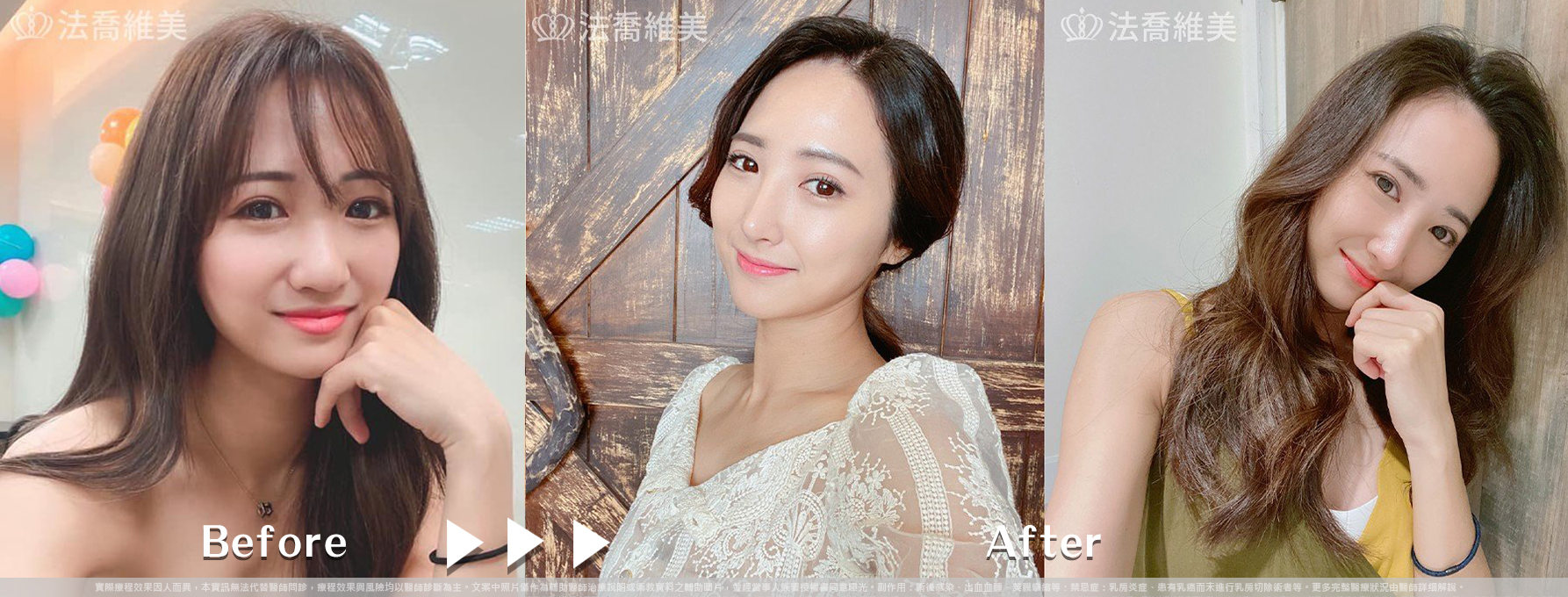 自體肋骨隆鼻,鼻截骨,術前畫線