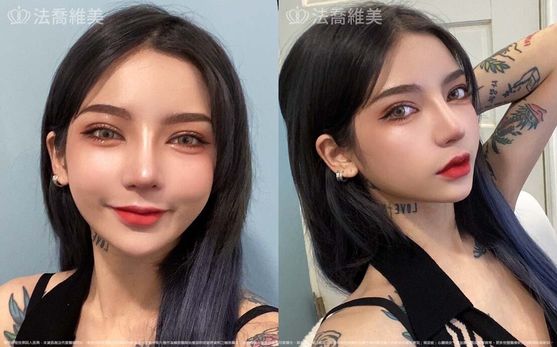 自體肋骨隆鼻,縮鼻翼