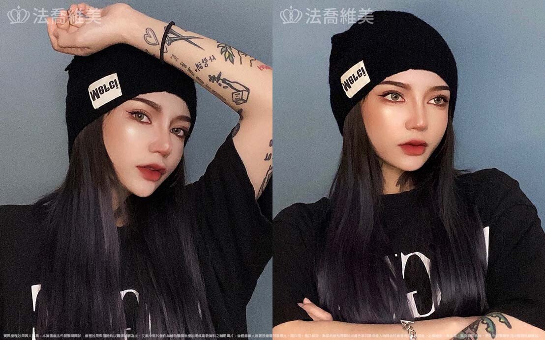 自體肋骨隆鼻,縮鼻翼