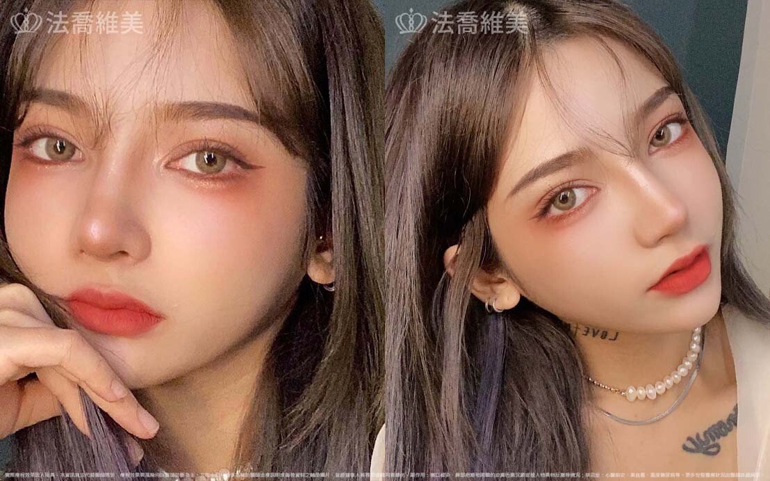 自體肋骨隆鼻,縮鼻翼