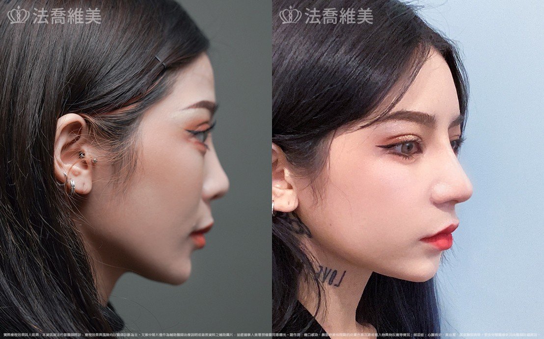 自體肋骨隆鼻,縮鼻翼