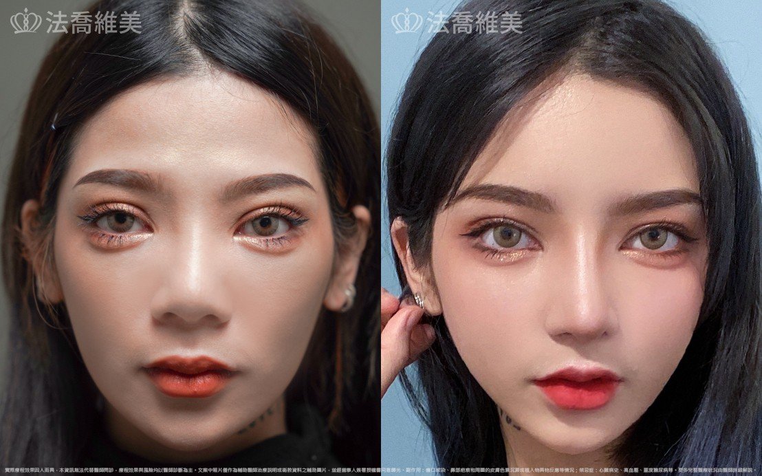 自體肋骨隆鼻,縮鼻翼