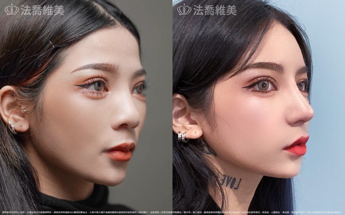 自體肋骨隆鼻,縮鼻翼