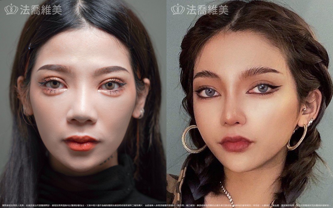 自體肋骨隆鼻,縮鼻翼