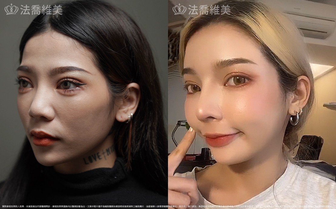 自體肋骨隆鼻,縮鼻翼