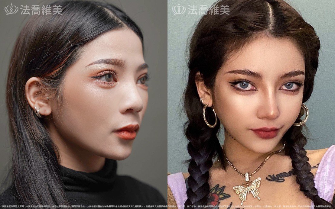 自體肋骨隆鼻,縮鼻翼