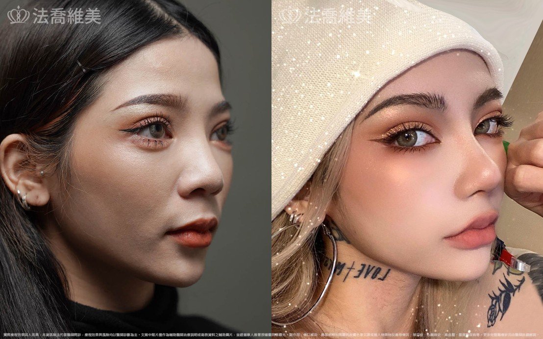 自體肋骨隆鼻,縮鼻翼