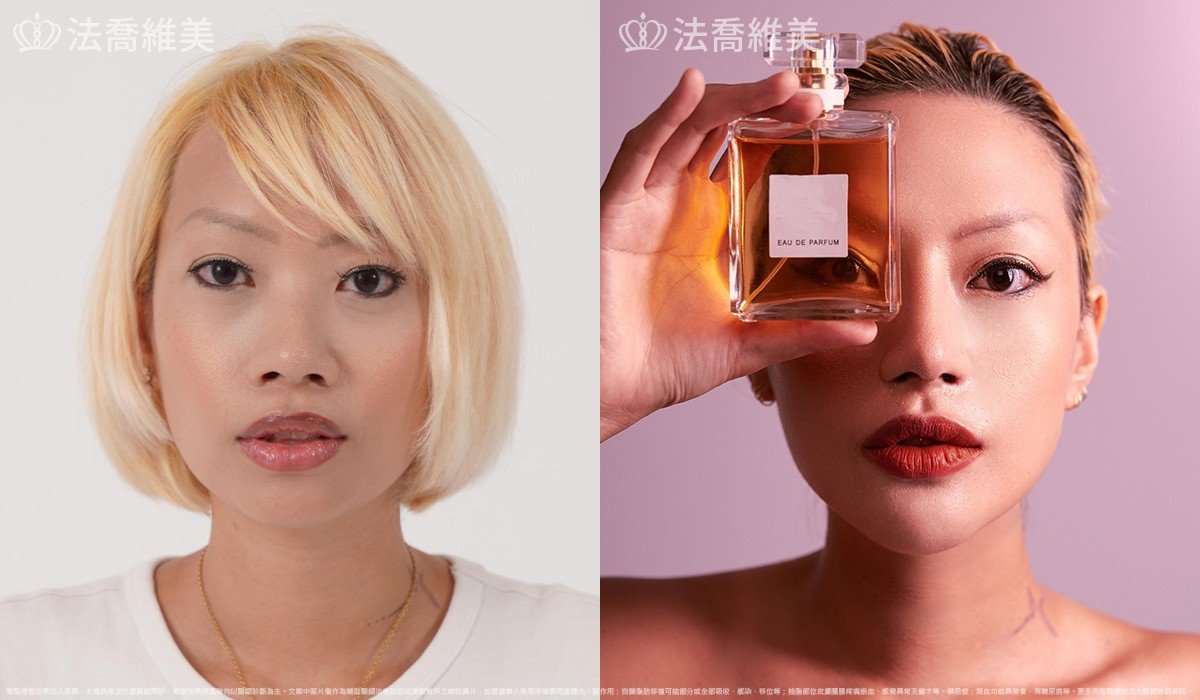 自體肋骨隆鼻,縮鼻翼,墊下巴
