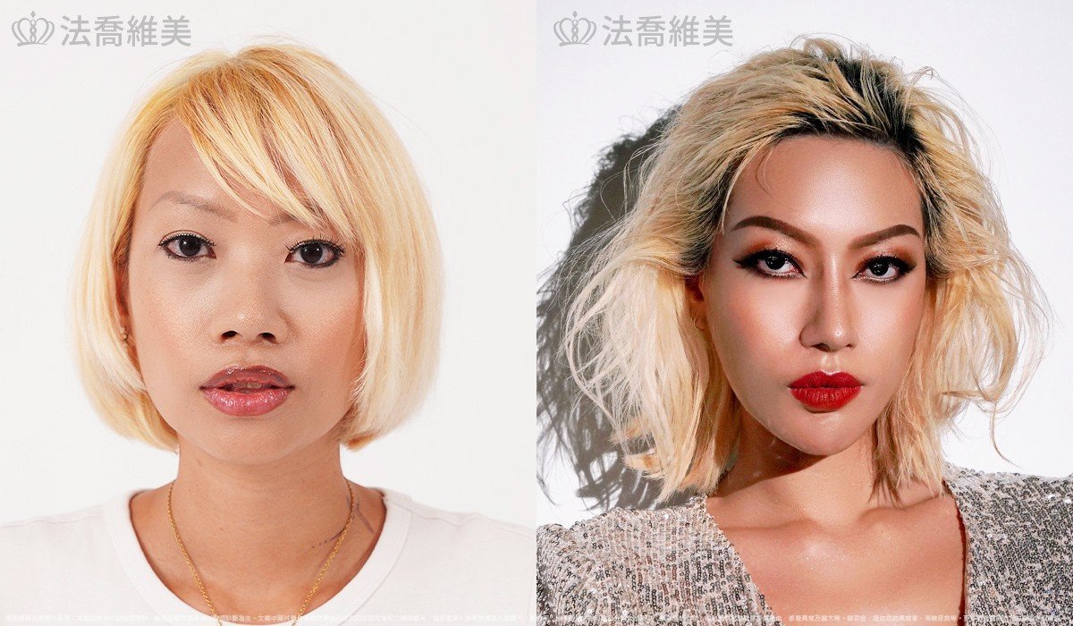 自體肋骨隆鼻,縮鼻翼,墊下巴