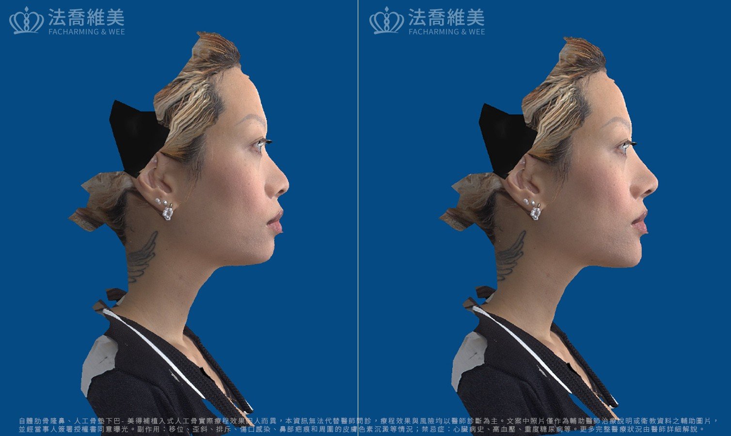 自體肋骨隆鼻,縮鼻翼,3D影像模擬圖