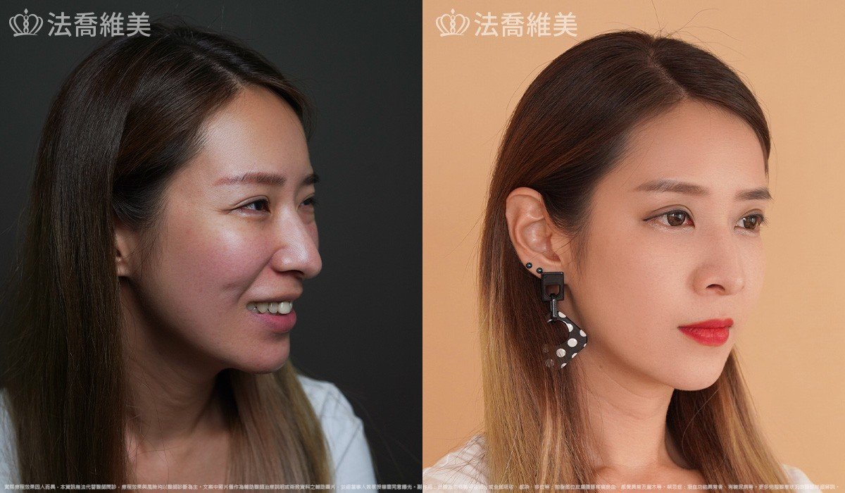 異體真皮鼻唇溝法令填補術,法令紋