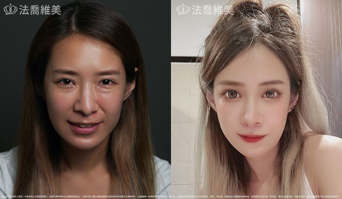 異體真皮鼻唇溝法令填補術,法令紋