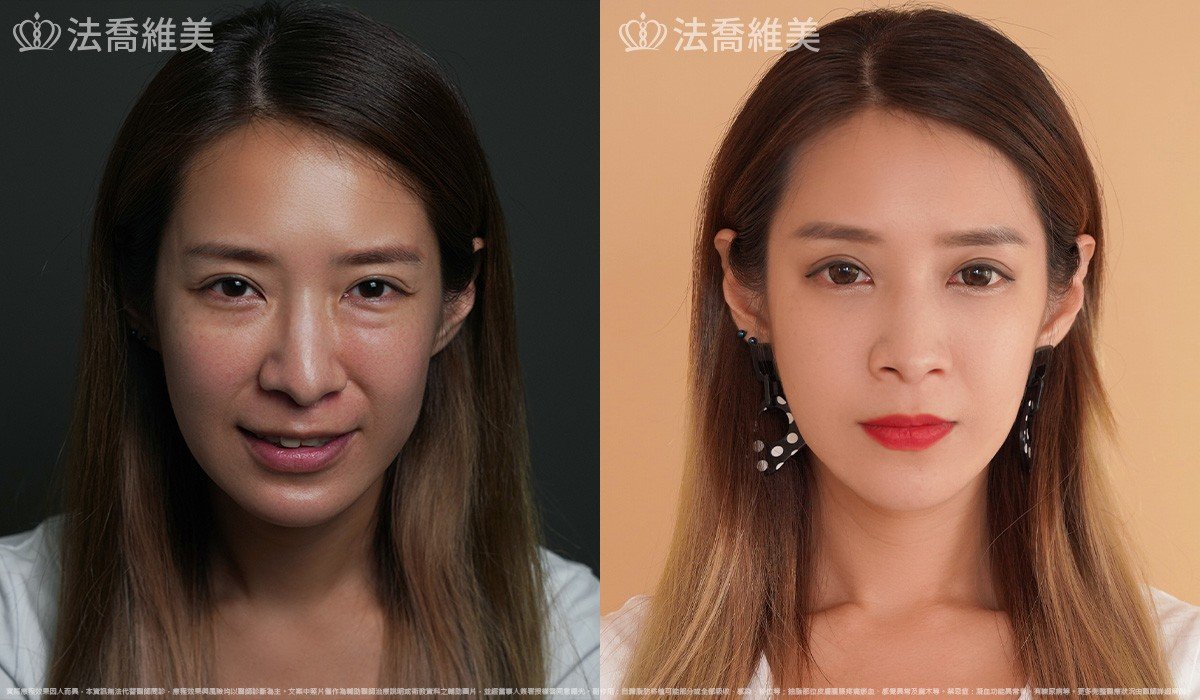 異體真皮鼻唇溝法令填補術,法令紋