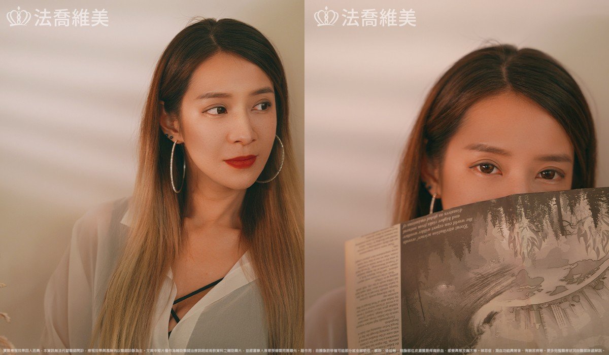 異體真皮鼻唇溝法令填補術,法令紋