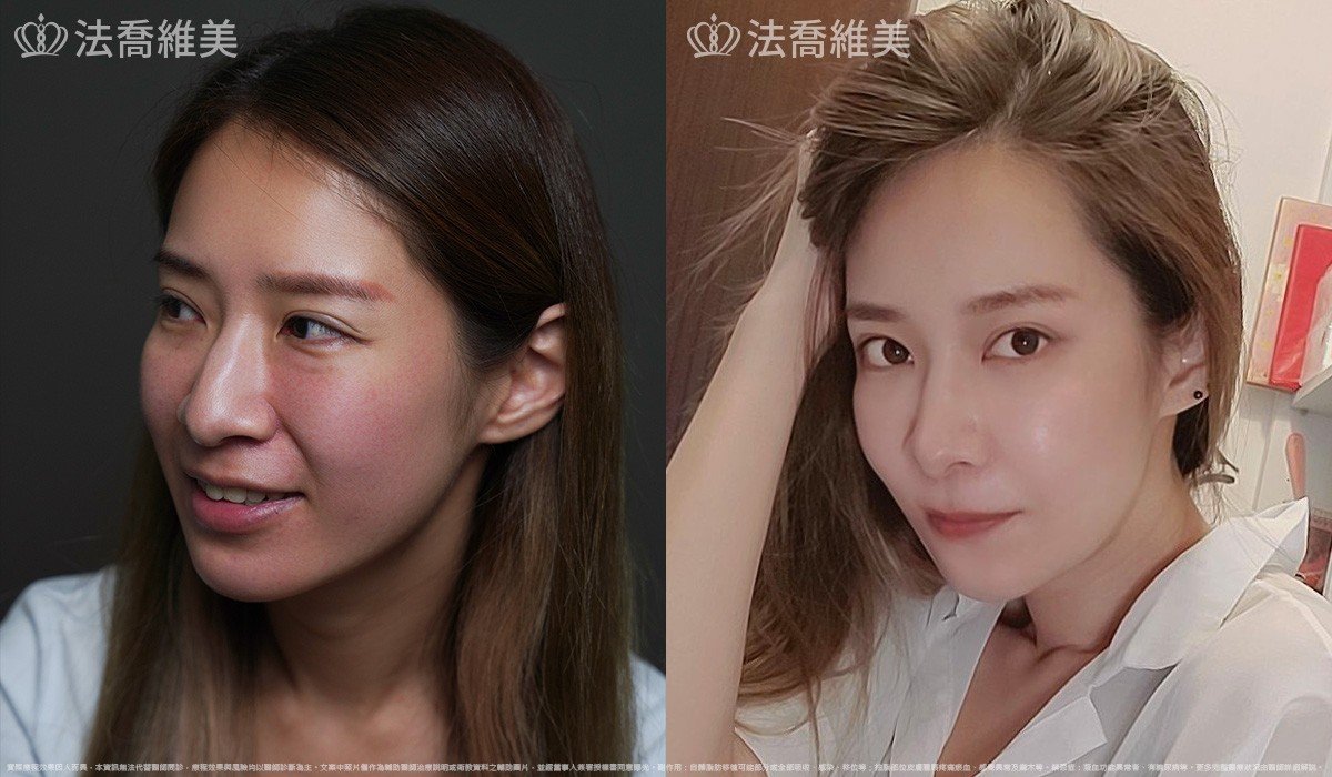 異體真皮鼻唇溝法令填補術,法令紋