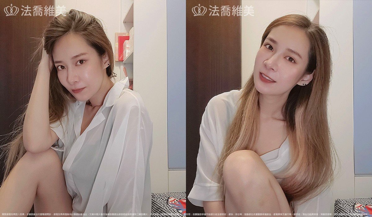 異體真皮鼻唇溝法令填補術,法令紋