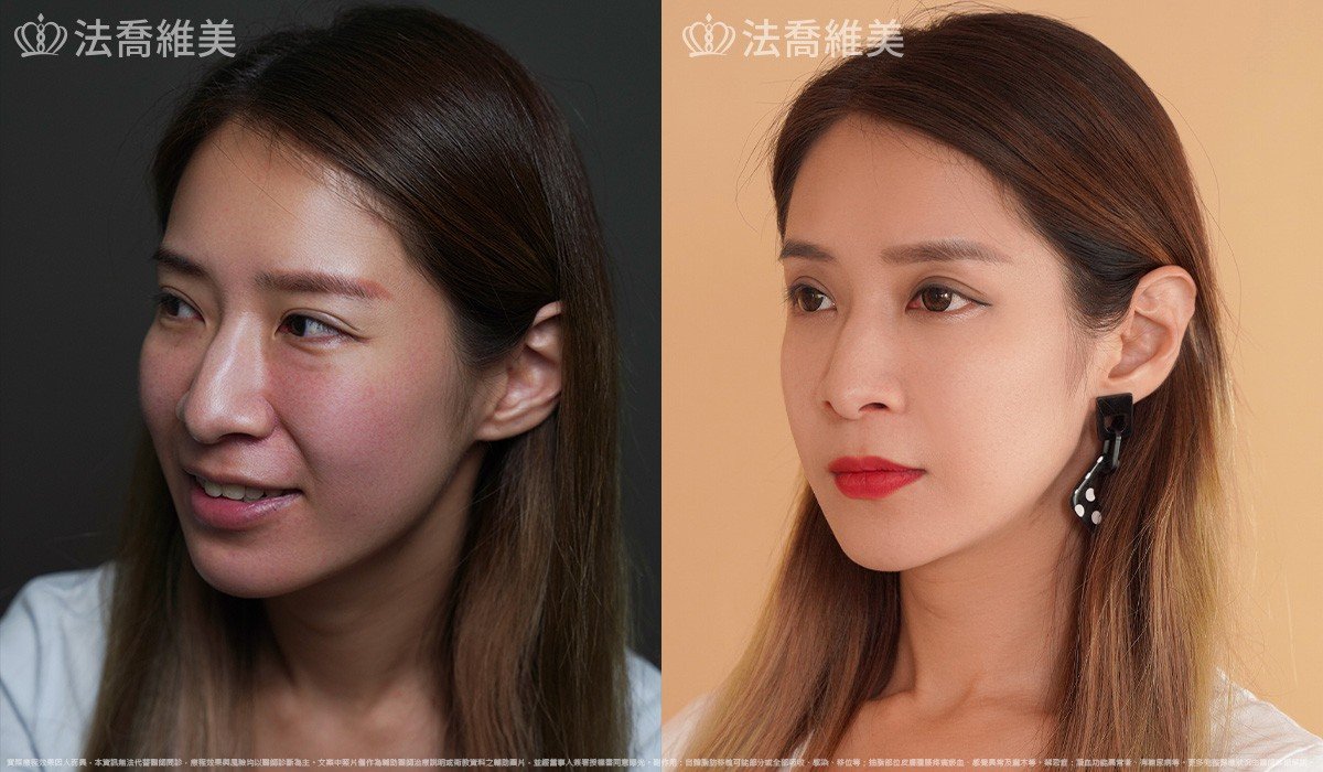 異體真皮鼻唇溝法令填補術,法令紋