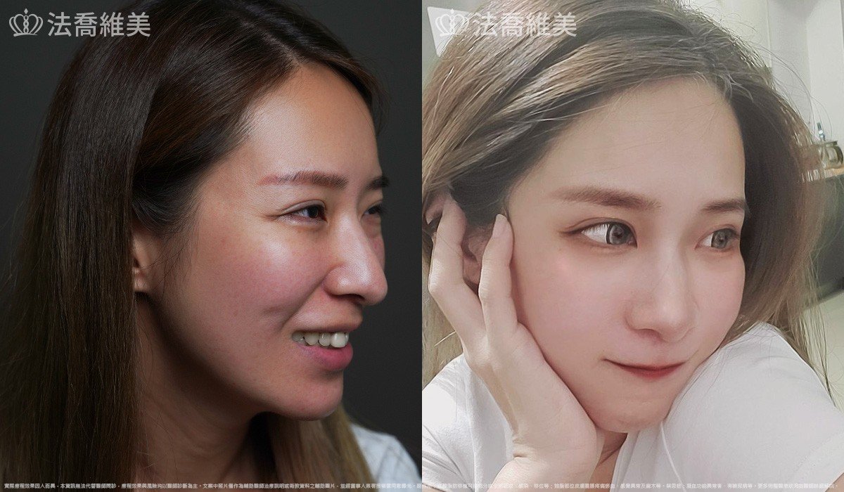 異體真皮鼻唇溝法令填補術,法令紋