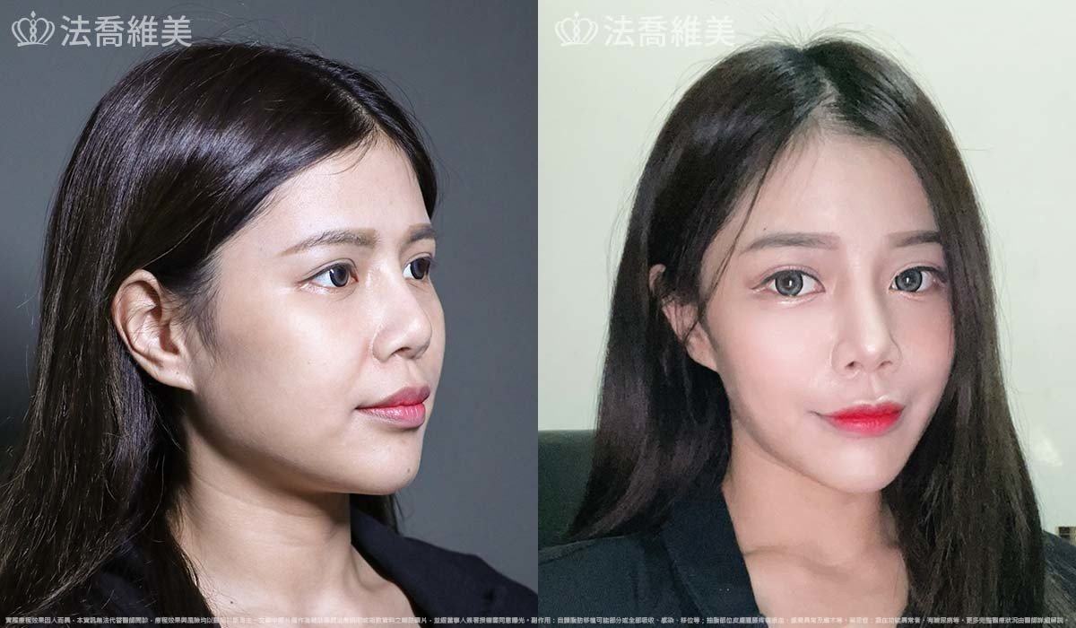 異體真皮鼻唇溝法令填補術,法令紋